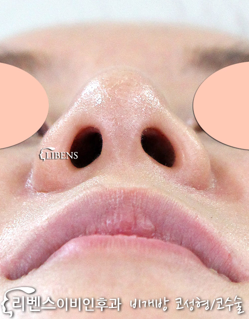 코 재수술 너무 높은 실리콘 제거 뾰적한 코끝 성형 수술  성형 s581